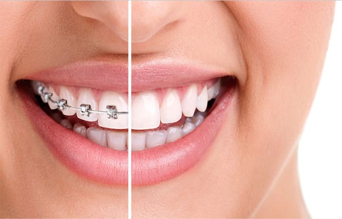 avant et après Orthodontie