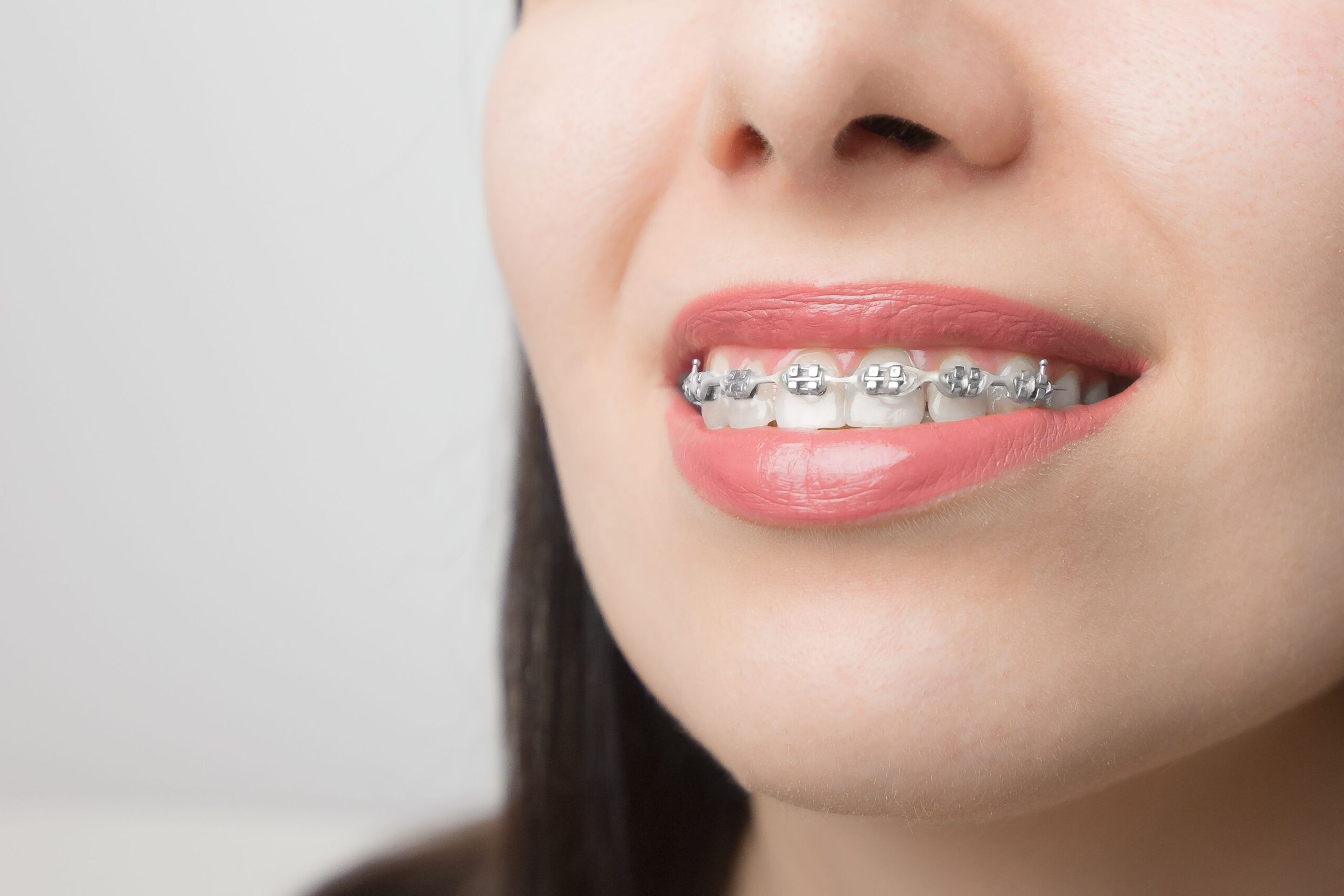 Imagen_1_braces_vs_aligners_10451d95c6